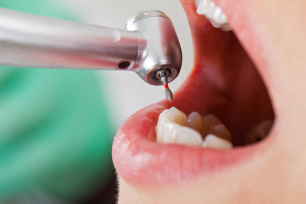 Best Emergency Root Canal Treatment in Corning, CA